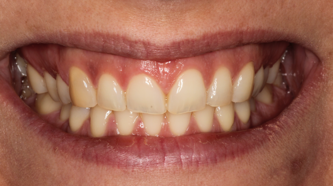Bekijk Als kauwen en soms ook lachen pijn doet op BITE Functional Dentistry