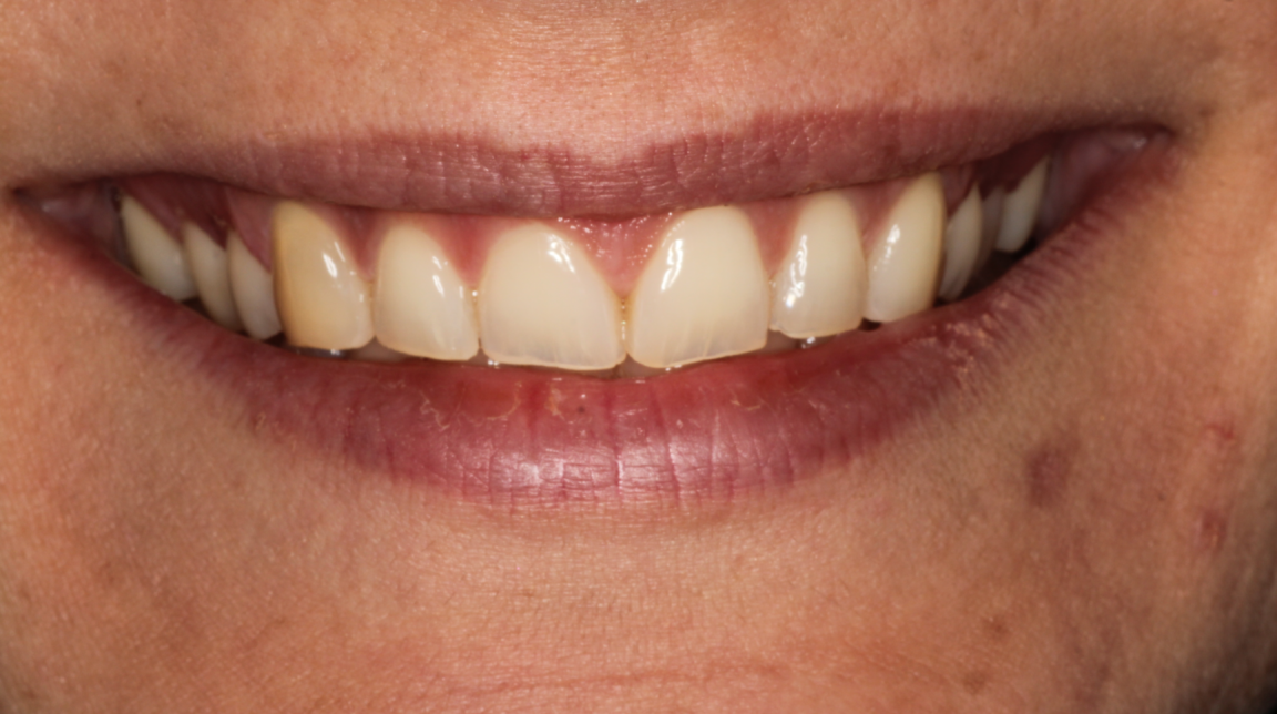 Bekijk Als kauwen en soms ook lachen pijn doet op BITE Functional Dentistry