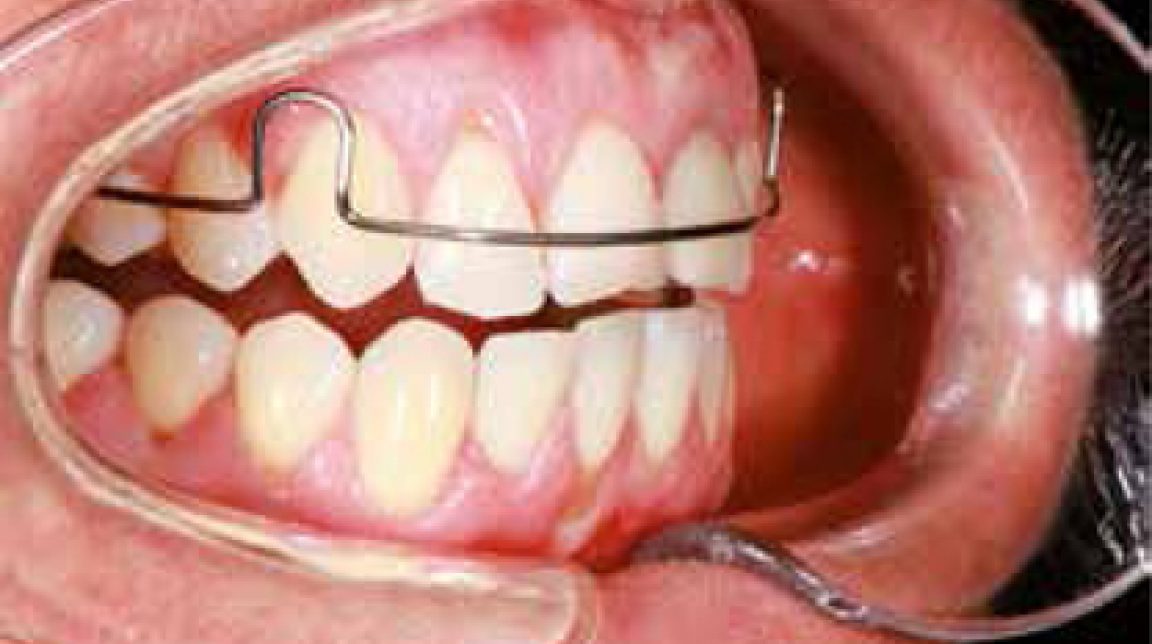 Bekijk Meer dan alleen een leuke theorie; CR of MO (deel 1) op BITE Functional Dentistry