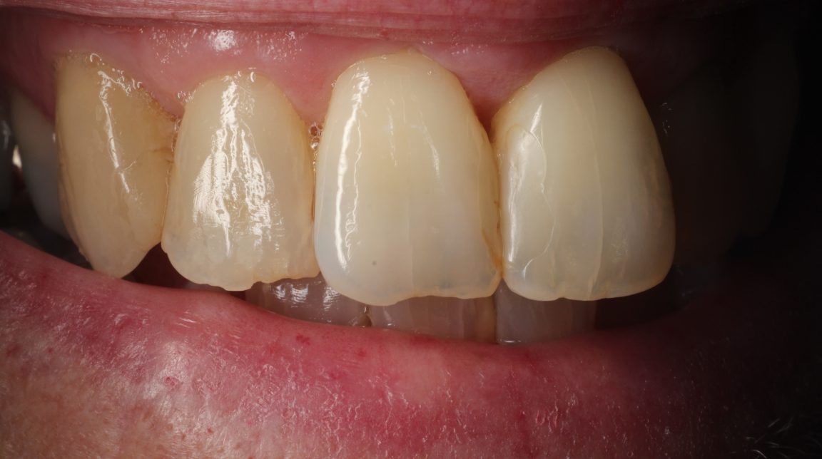 Bekijk Op elkaars lip op BITE Functional Dentistry