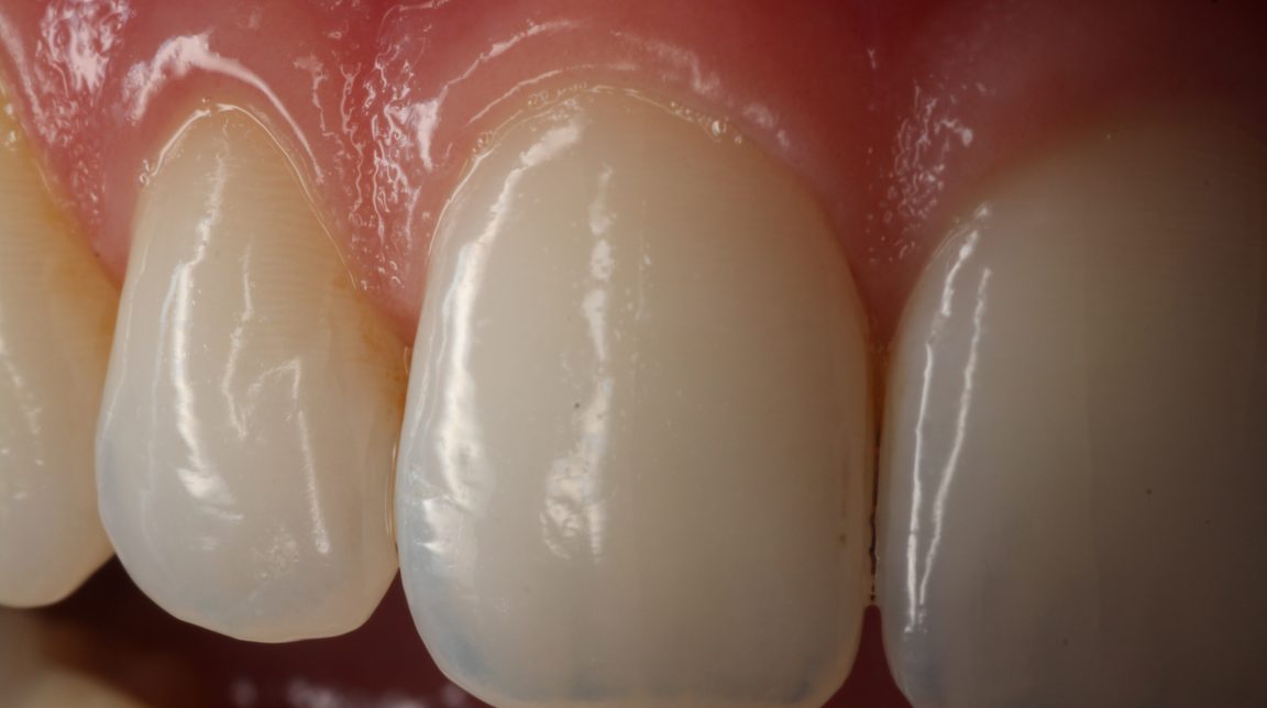 Bekijk Esthetische kaders op BITE Functional Dentistry