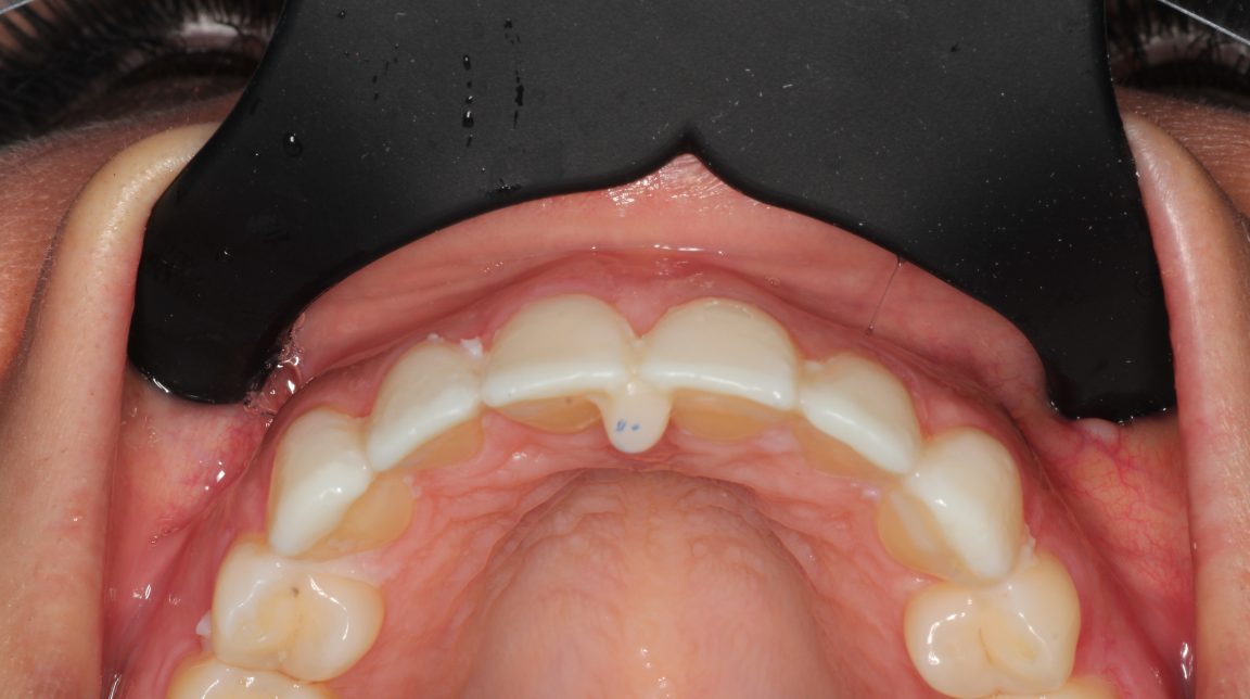 Bekijk Als kauwen en lachen weer mogelijk is (deel 2) op BITE Functional Dentistry