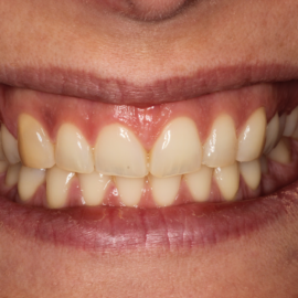Bekijk deze Als kauwen en soms ook lachen pijn doet op BITE Functional Dentistry 
