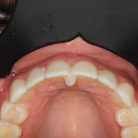 Bekijk deze Als kauwen en lachen weer mogelijk is (deel 2) op BITE Functional Dentistry 