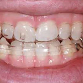 Bekijk deze Een vragenlijst in de algemene praktijk? De meerwaarde op BITE Functional Dentistry 