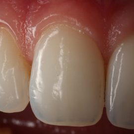 Bekijk deze Esthetische kaders op BITE Functional Dentistry 