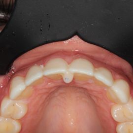Bekijk deze Als kauwen en lachen weer mogelijk is (deel 2) op BITE Functional Dentistry 