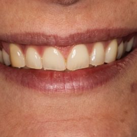Bekijk deze Als kauwen en soms ook lachen pijn doet op BITE Functional Dentistry 