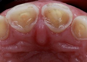 Bekijk deze Tooth wear management op BITE Functional Dentistry 