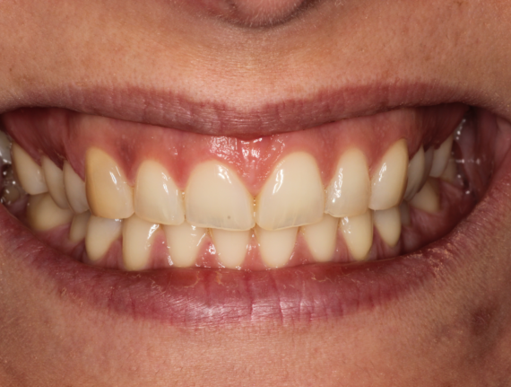 Bekijk deze Als kauwen en soms ook lachen pijn doet op BITE Functional Dentistry 