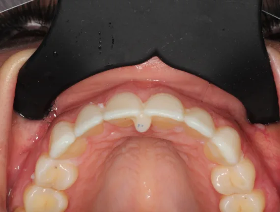 Bekijk deze Als kauwen en lachen weer mogelijk is (deel 2) op BITE Functional Dentistry 
