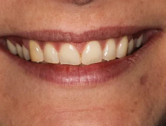 Bekijk deze Als kauwen en soms ook lachen pijn doet op BITE Functional Dentistry 