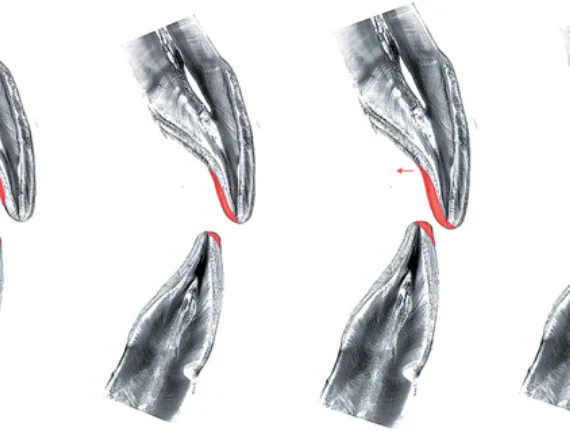 Bekijk deze Beter interpreteren na correct registreren (deel 2) op BITE Functional Dentistry 