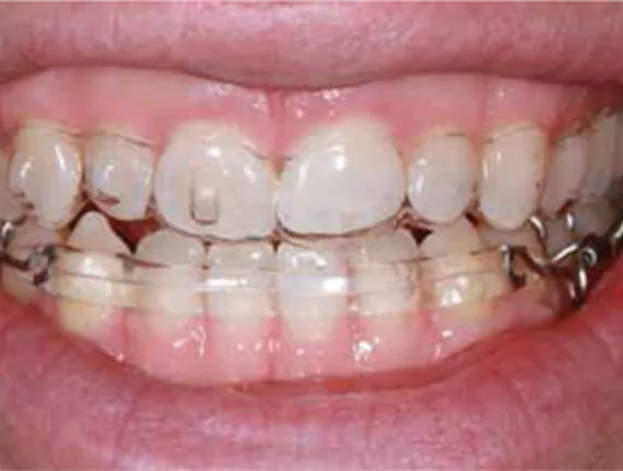 Bekijk deze Een vragenlijst in de algemene praktijk? De meerwaarde op BITE Functional Dentistry 